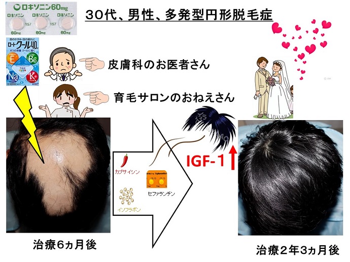 円形脱毛症　病院